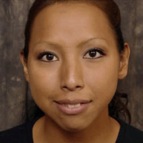 Woman smilling looking at us before surgery