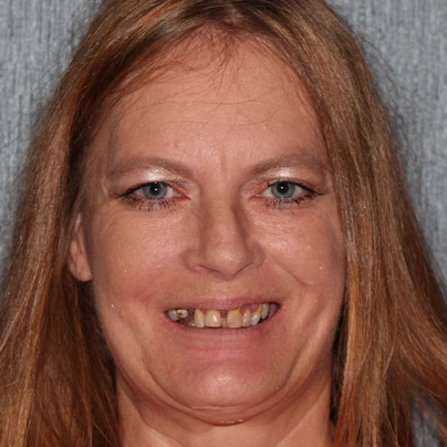 Lori patient smilling before surgery
