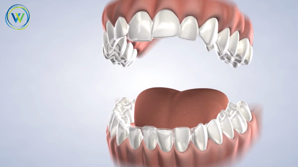 Clear aligners 3d