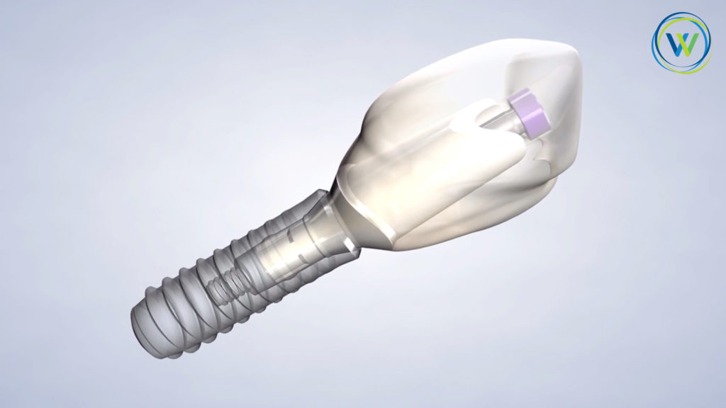 Implant 3d image with blue background
