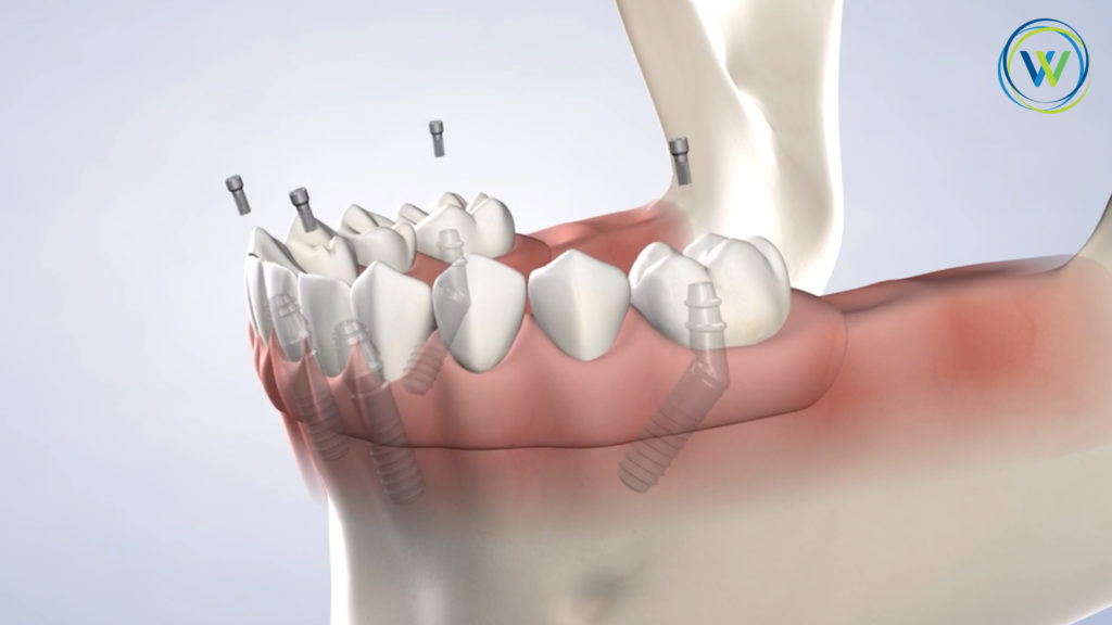 procedure-full-arch-restoration 3d