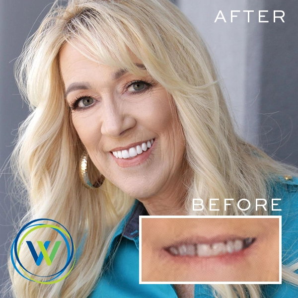 winterholler-before-after graphic