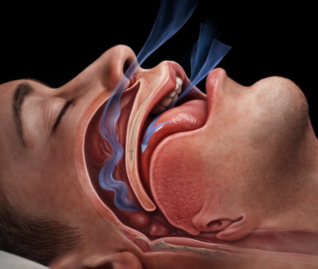 Man sleeping with the a graphic of the airway from the side