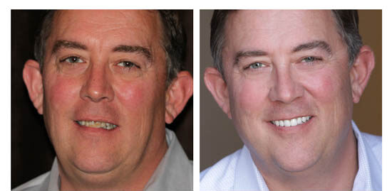 before-after-andrew side by side