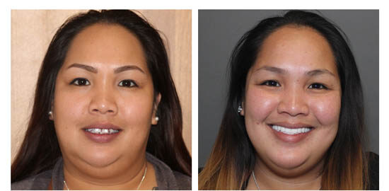 before-after-justine side by side