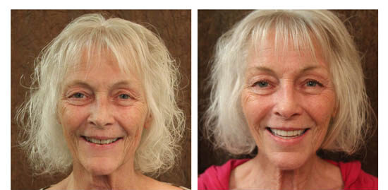 before-after-lee side by side