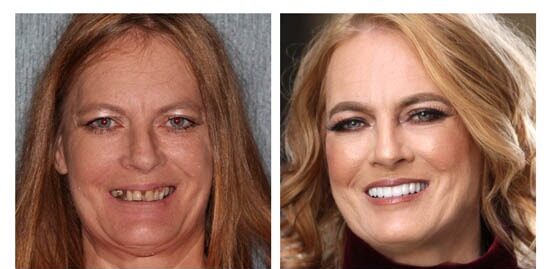 before-after-lori side by side