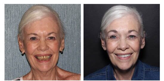 before-after-salley side by side