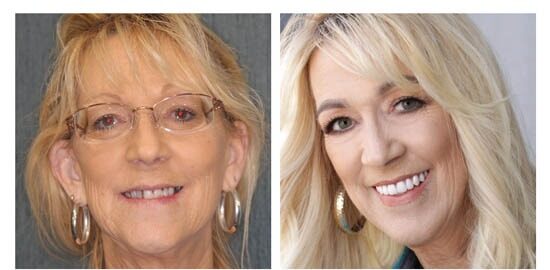 before-after-shirley side by side