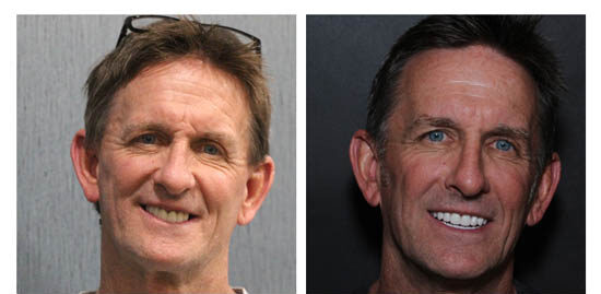 before-after-william side by side