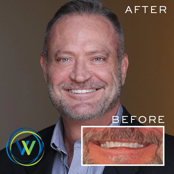 winterholler-before-after graphic