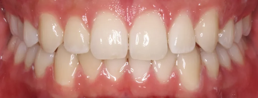 After-Clear-Aligners-Spacing-Teeth
