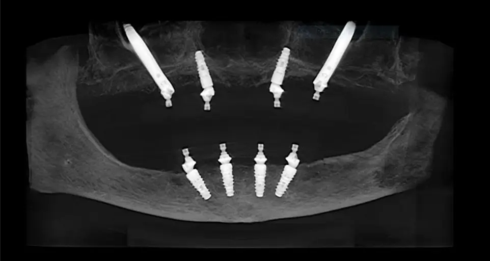CT scan of implants