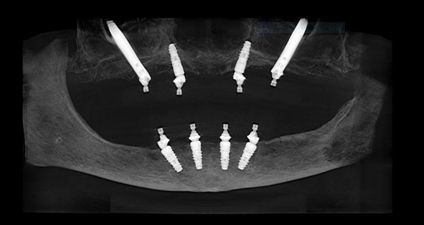 ct scan implants