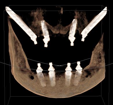 ct scan implants
