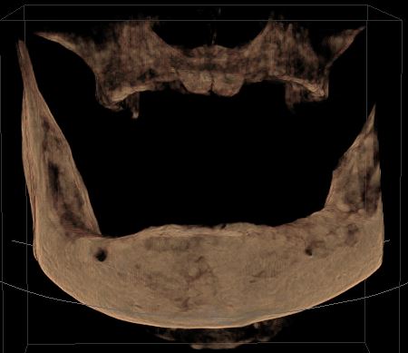 CT scan of a mouth without teeth