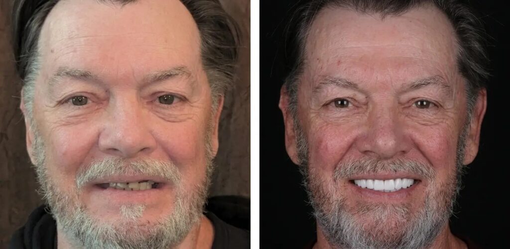 before and after of a male patient