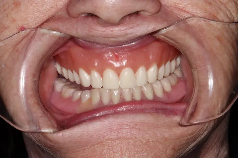 Zirconia teeth attached on a client