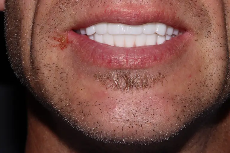 smilling patient after surgery