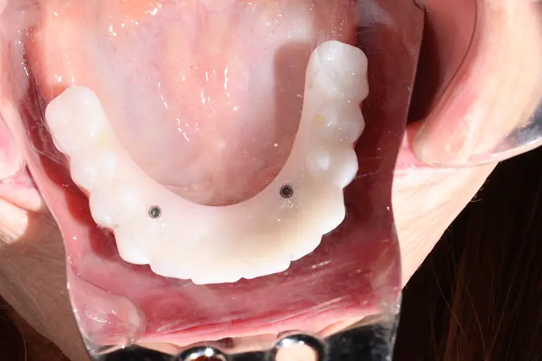 Implant screwed in