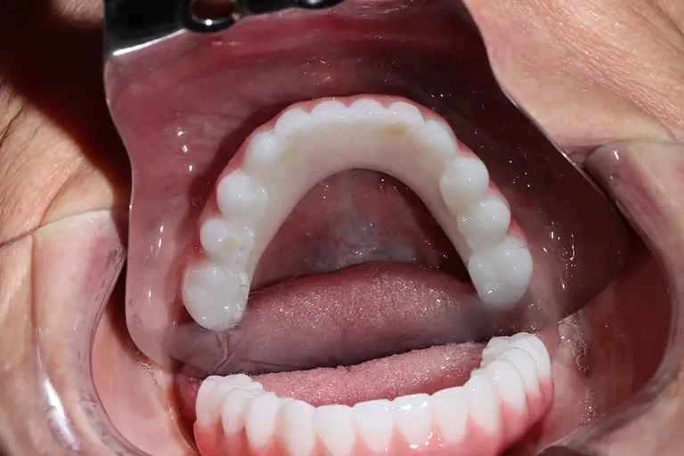 Implant screwed in