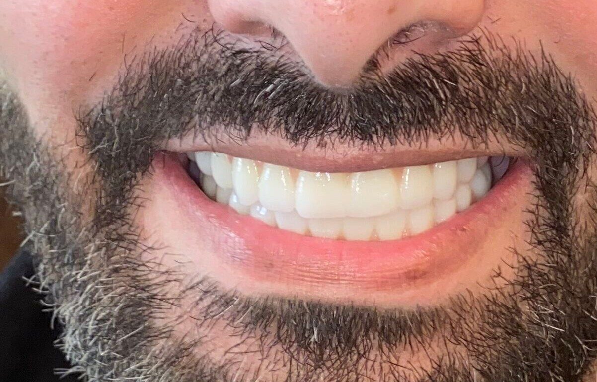 client smilling after surgery