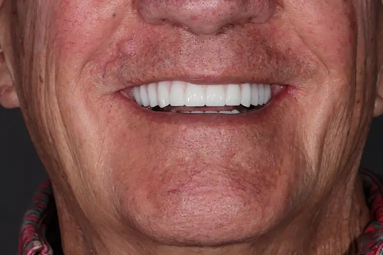 client after surgery smilling