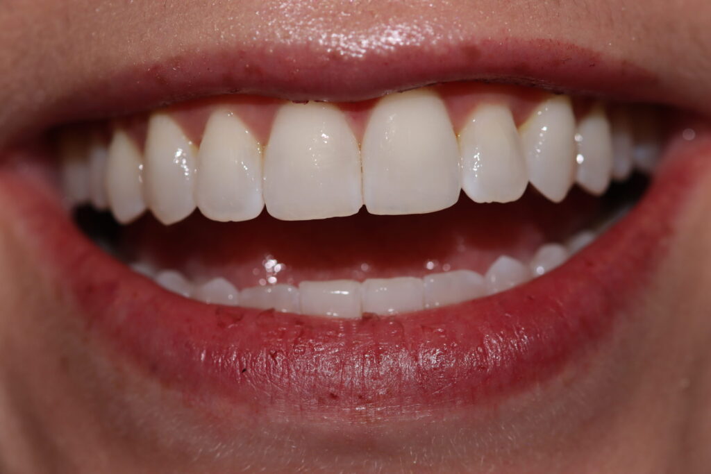 smilling patient after surgery