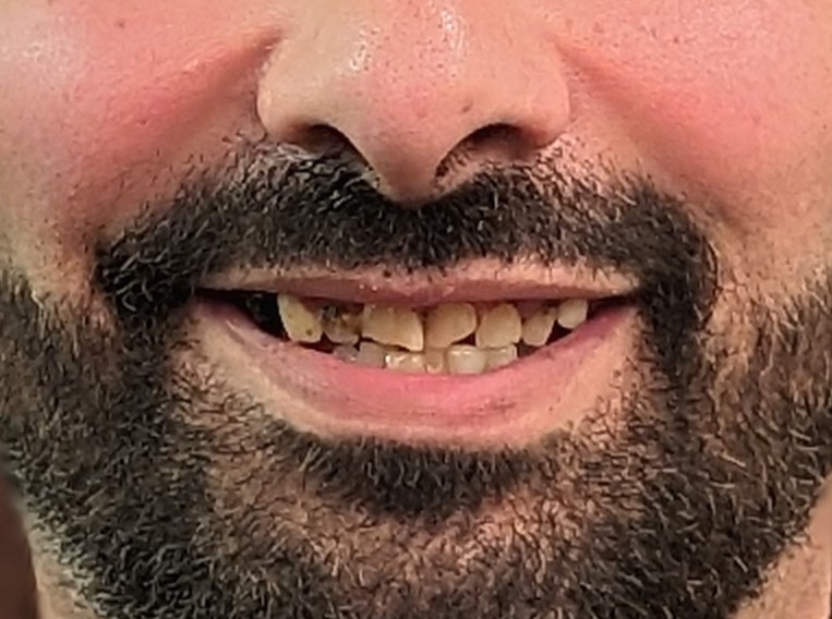 client smilling before surgery