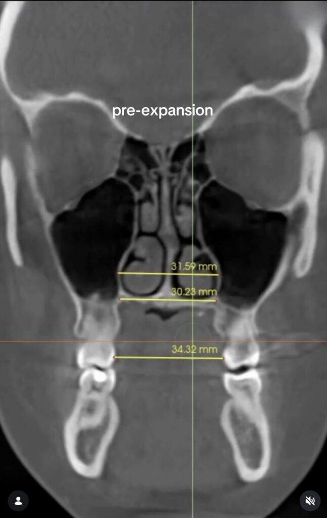 pre-expansion ct scan