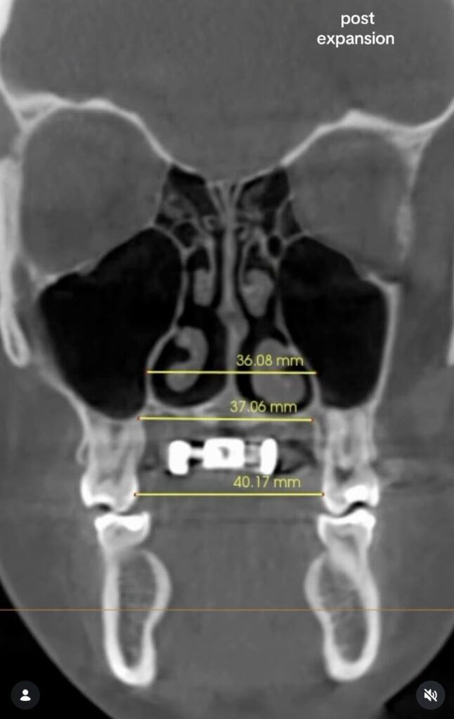 post-expansion ct scan
