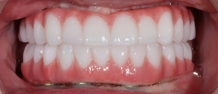 zygomatic implants attached on a client