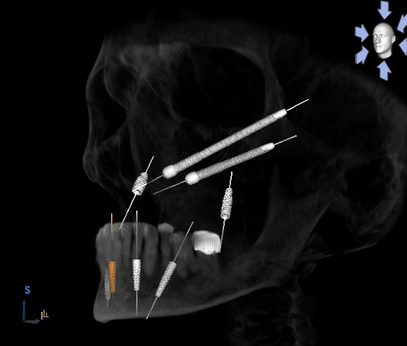 Zygo CT scan