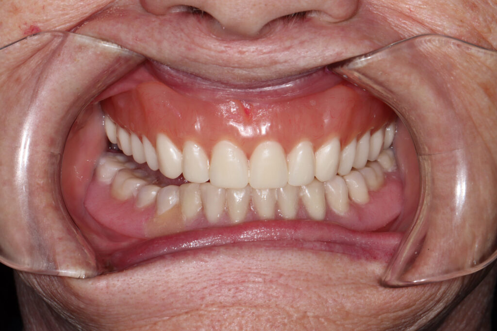 Pyterygoid Implants attached on a client