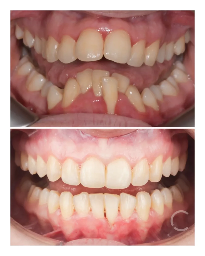 Before and after attaching the expander