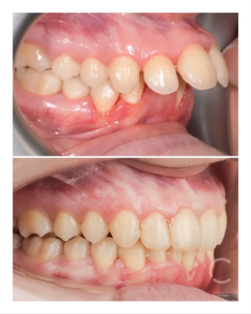 dome expander before and after