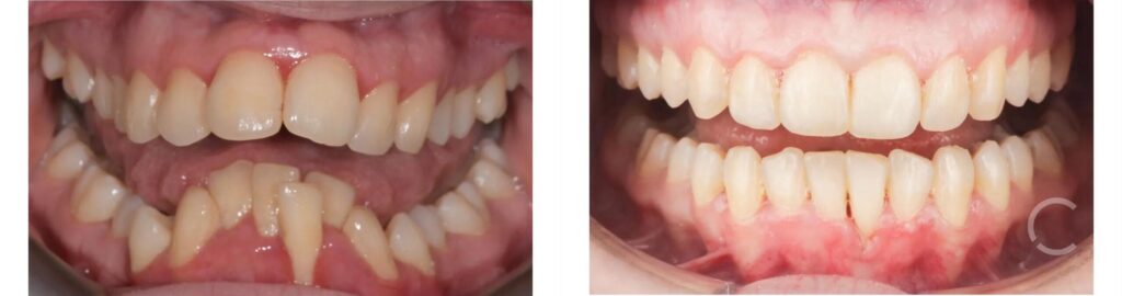 before and after
