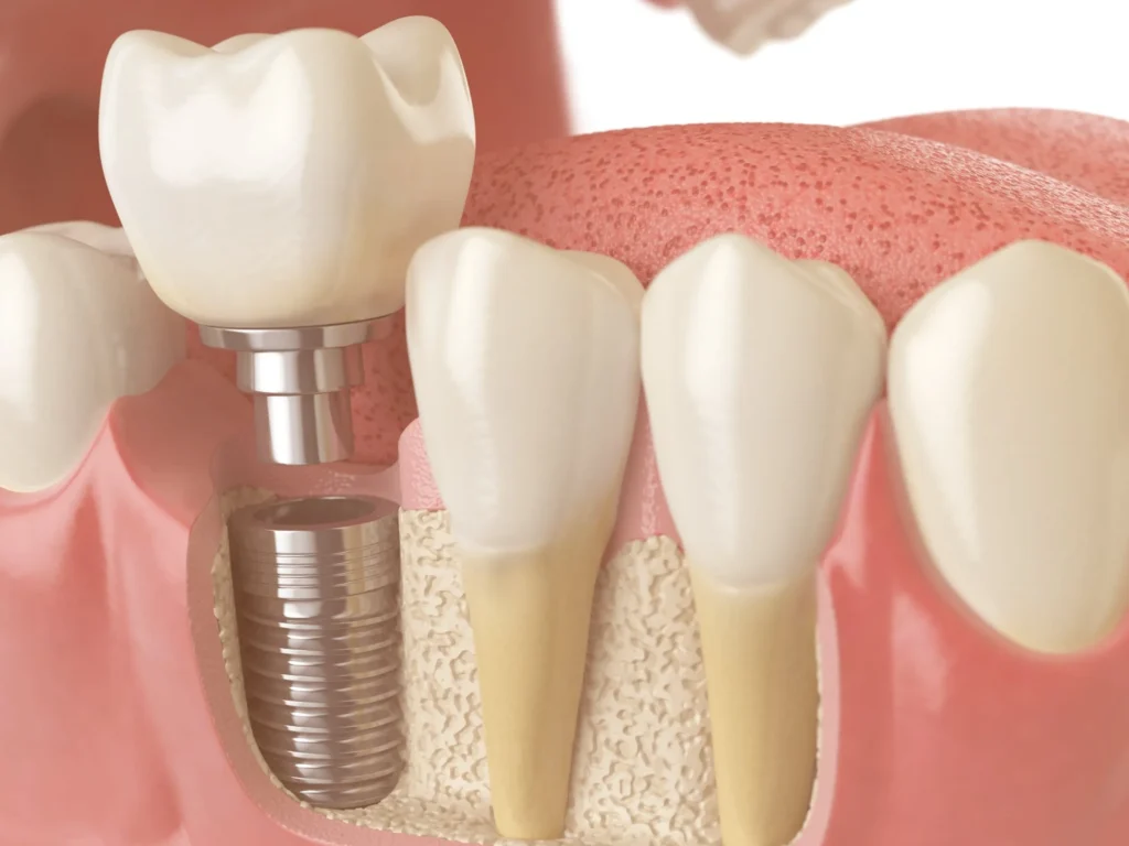 bone grafting 3d illustration