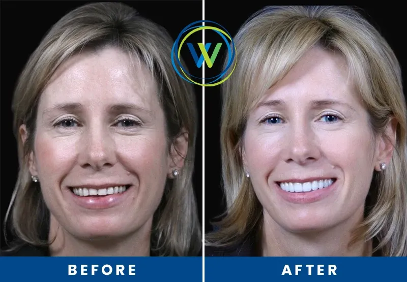 before-after