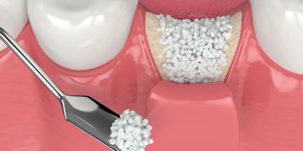 bone grafting 3d illustration