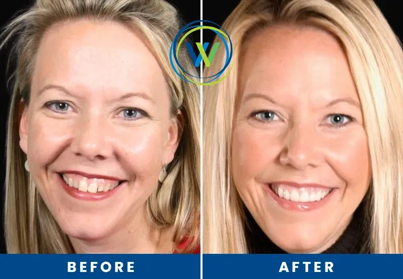 before-after