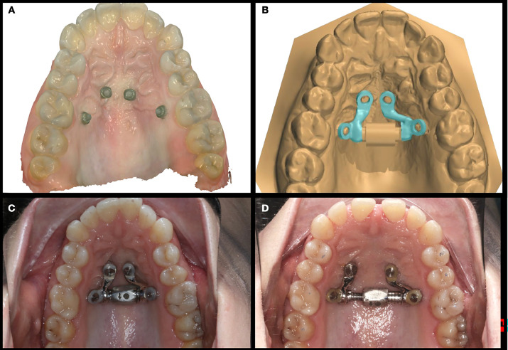 dome expander before and after