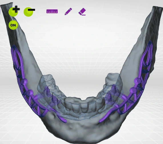 CT scan of suppoting metal for implants