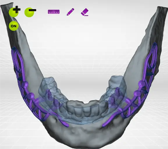 CT scan of suppoting metal for implants