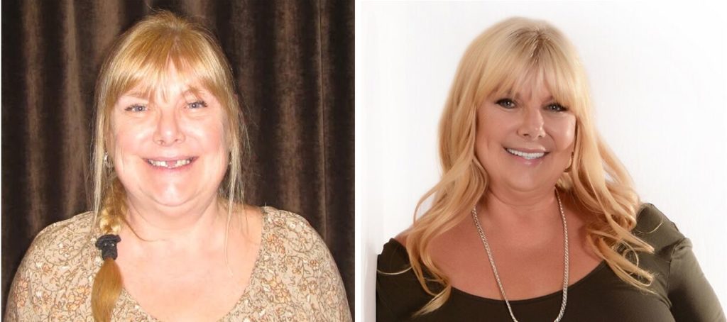 dental implants dr winterholler